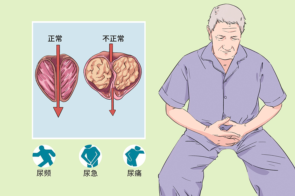 前列腺钙化