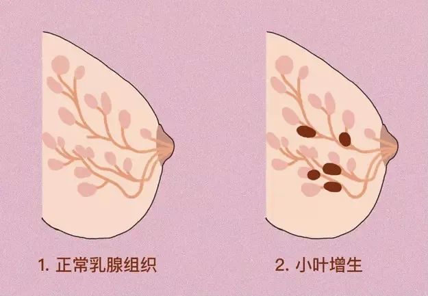 乳腺结节图解图片