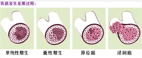 乳腺癌病变过程