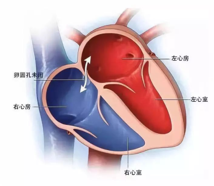 卵圆孔未闭