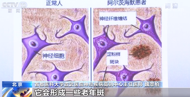 阿尔茨海默症